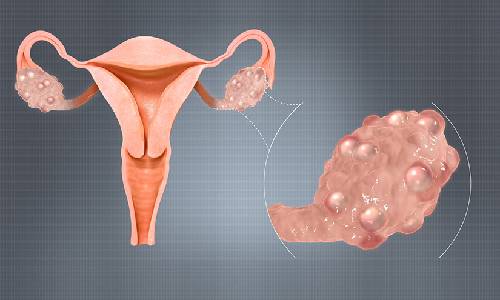 PCOS Treatment